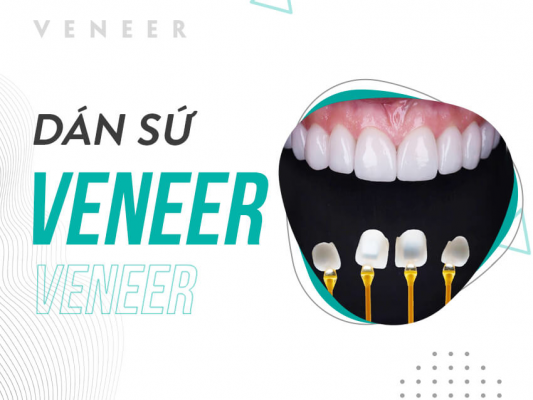 DÁN SỨ VENEER