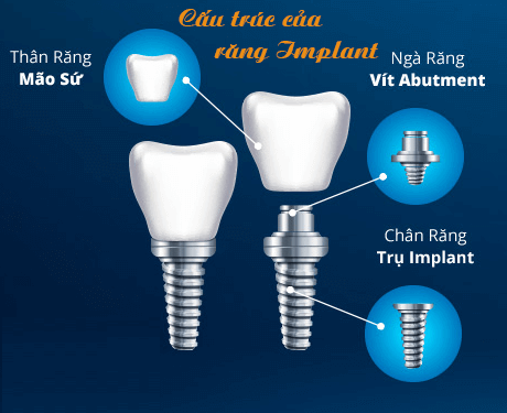 TRỒNG RĂNG IMPLANT