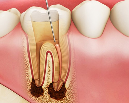 điều trị tủy răng