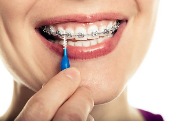 Có niềng răng 1 hàm được không? Giải đáp từ các chuyên gia 2 Nieng rang thua 1 ham gia bao nhieu