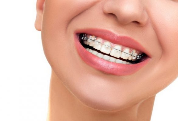 Có niềng răng 1 hàm được không? Giải đáp từ các chuyên gia 3 Nieng rang 1 ham duoc khong