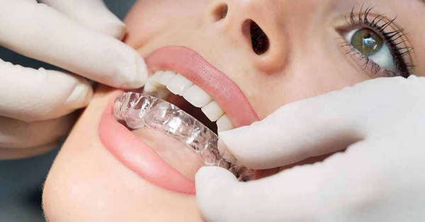 giai dap thac mac nieng rang invisalign co dat khong2