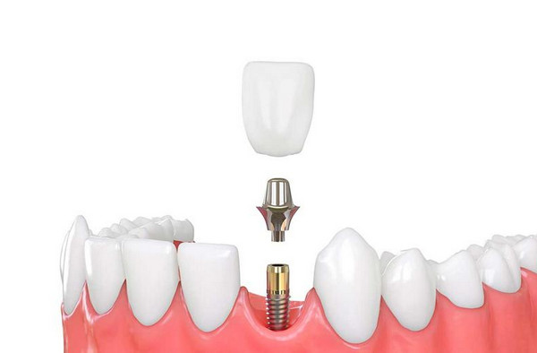 quy trinh trong rang implant 1