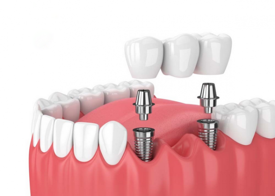 thoi gian tien hanh trong rang implant 1