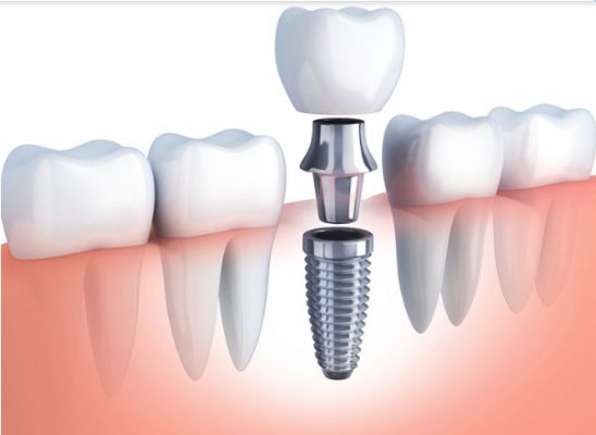 trong rang implant 2