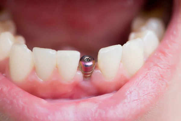 trong rang implant gia bao nhieu 2