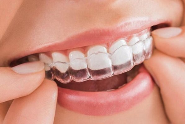 3 cach giup giu khay nieng rang invisalign sach se trong suot 1