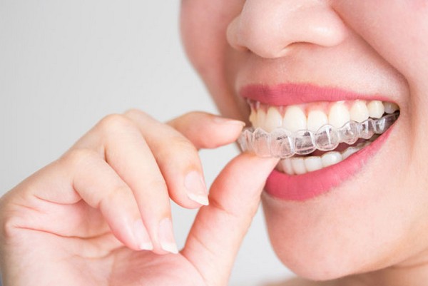 Nieng rang Invisalign phu hop cho nhung doi tuong nao 1