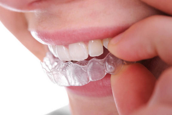 bi viem loi co nieng rang invisalign duoc khong 3