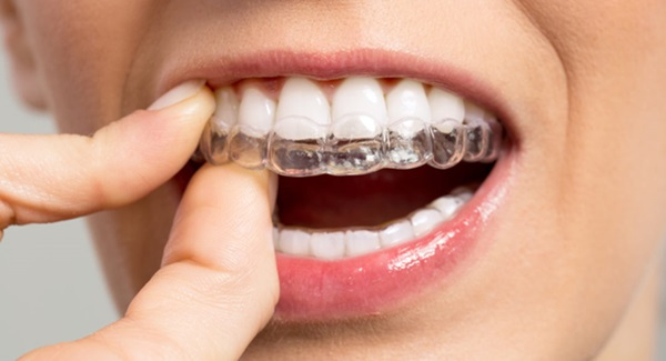 vi sao nen nieng rang invisalign tai nha khoa tuan hung 3